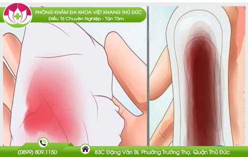 giua-kinh-nguyet-ra-mau-nau