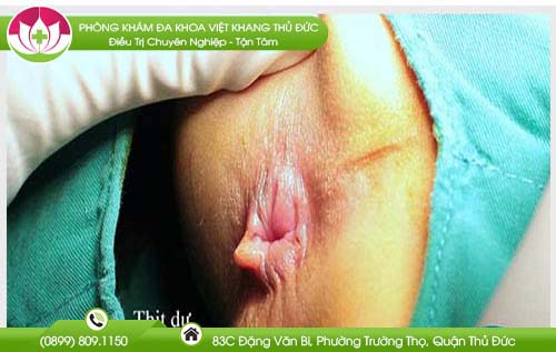 Hậu môn có cục thịt dư có nguy hiểm không?