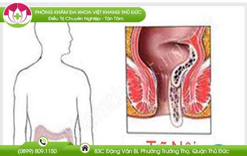Hiện tượng trĩ nội tắc mạch là gì? có nguy hiểm không