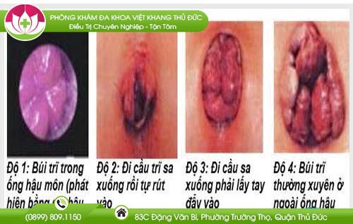 hinh-anh-benh-tri-giai-doan-dau