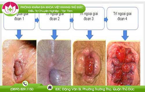 Nhận biết hình ảnh bệnh trĩ giai đoạn đầu qua từng cấp độ cụ thể