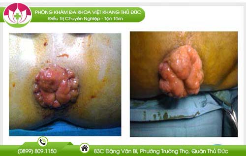 hinh-anh-benh-tri-giai-doan-dau
