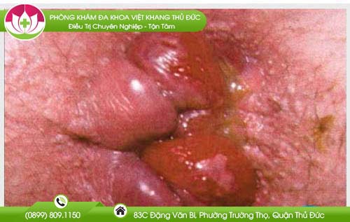 hinh-anh-benh-tri-ngoai-nhe