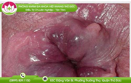 hinh-anh-benh-tri-ngoai-nhe