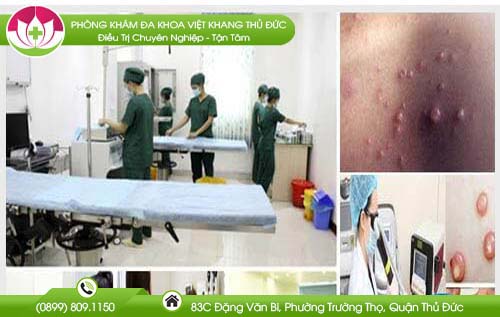 hinh-anh-benh-u-mem-lay