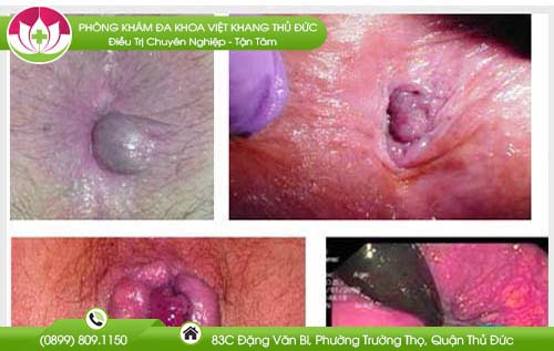 Hình ảnh hậu môn phụ nữ mắc bệnh trĩ và các triệu chứng