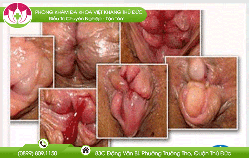 Hình ảnh nứt hậu môn