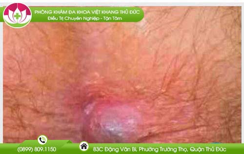 hinh-anh-tri-ngoai-giai-doan-dau