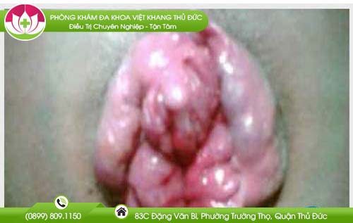 hinh-anh-tri-ngoai-giai-doan-dau