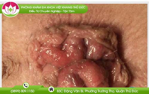 hinh-anh-tri-ngoai-nhe