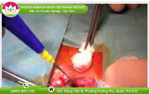hinh-anh-tri-ngoai-nhe