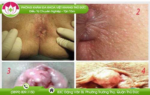 Phát hiện bệnh trĩ tại nhà với hình ảnh trĩ nội và trĩ ngoại chân thực