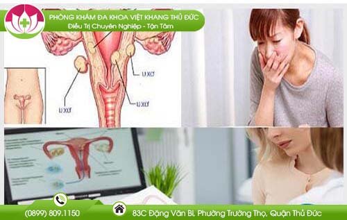 Đi tìm khám u xơ tử cung ở đâu tốt nhất TP HCM cho chị em