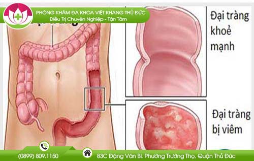 Không nên xem nhẹ bệnh viêm loét đại trực tràng chảy máu