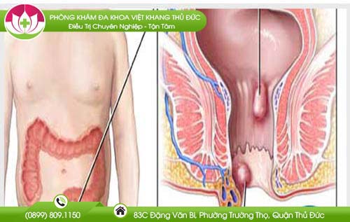 Làm thế nào để búi trĩ co lên?