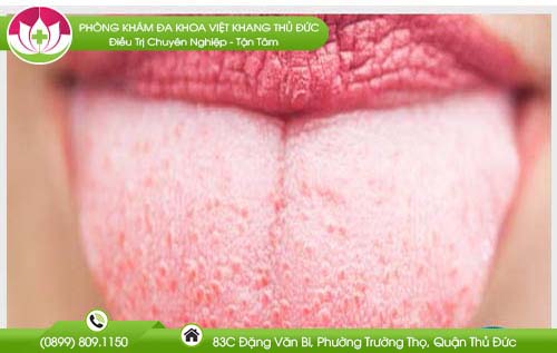 luoi-bi-noi-hot