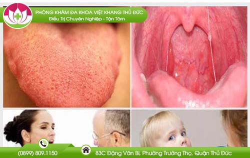 luoi-bi-noi-hot