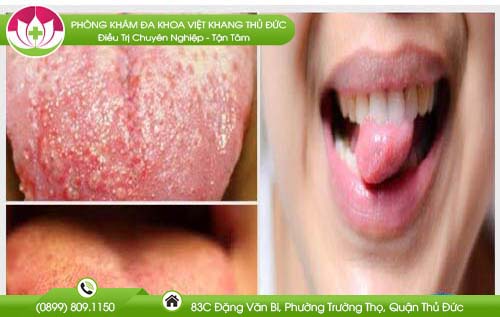 Lưỡi bị nổi hột có phải mắc bệnh xã hội? Tư vấn sức khỏe