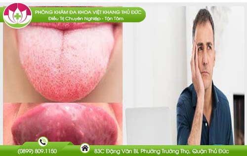 Lưỡi có nốt đỏ là dấu hiệu bệnh gì? Có nguy hiểm không