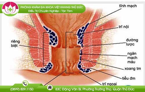 mac-benh-tri-co-dau-bung-khong