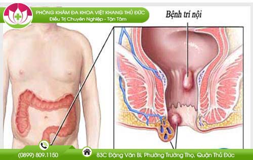 Mắc bệnh trĩ dễ gây hẹp hậu môn