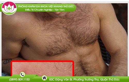moc-mun-o-biu-co-quan-sinh-duc-nam