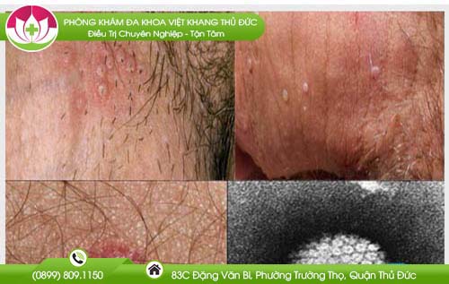 Mọc mụn ở bìu cơ quan sinh dục nam là bệnh gì và do đâu?