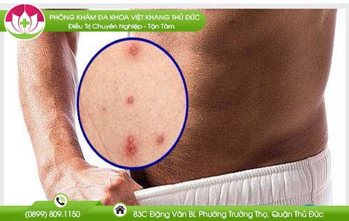 Mọc mụn ở bìu cơ quan sinh dục nam nguyên nhân do đâu và cách điều trị