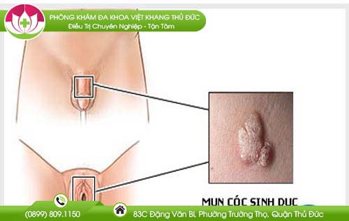 mun-coc-sinh-duc