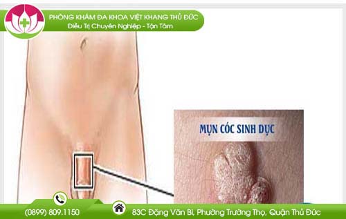 mun-coc-sinh-duc-nam