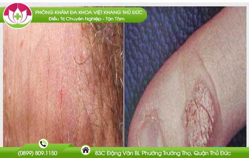 Cách nhận biết bệnh mụn cóc sinh dục nam chính xác 100%