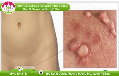 Tìm hiểu về bệnh mụn cóc sinh dục nữ - Bệnh xã hội