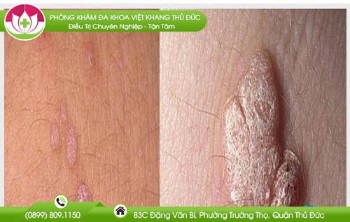 mun-coc-sinh-duc-nu