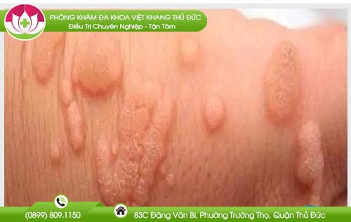 mun-coc-sinh-duc-nu