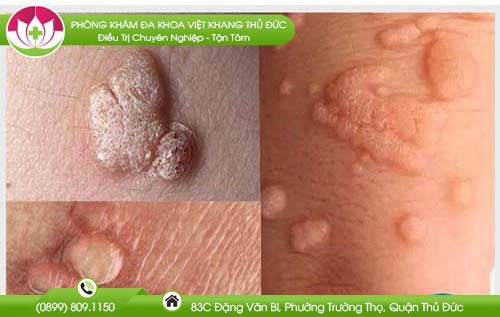 Bệnh mụn cóc sinh dục và những điều cần biết