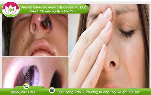 Đi tìm nguyên nhân mụn mọc trong mũi và cách chữa trị nhanh chóng