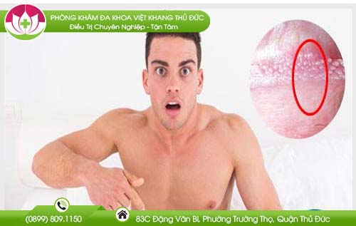 Mụn nhỏ màu trắng ở rãnh bao quy đầu có nguy hiểm không? Có bị sùi mào gà