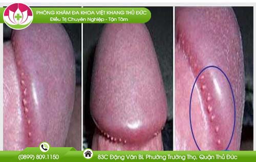 mun-nho-mau-trang-o-ranh-bao-quy-dau