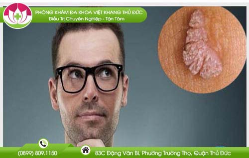 Bị mụn thịt ở bộ phận sinh dục nam và nữ giới là bệnh gì?
