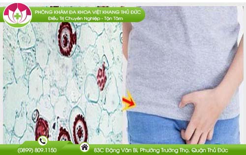 Bệnh nấm ngứa vùng kín và cách điều trị hiệu quả nhất