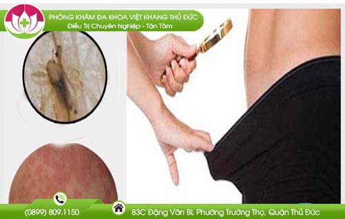 Ngứa lông mu là bệnh gì và khám ở đâu an toàn chính xác