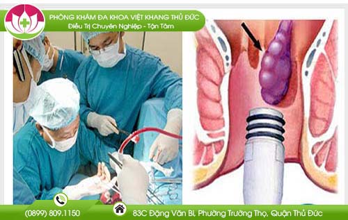 Người bệnh sau khi thắt búi trĩ cần có chế độ chăm sóc thế nào?