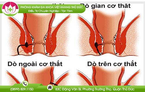 Nguyên nhân bệnh rò hậu môn