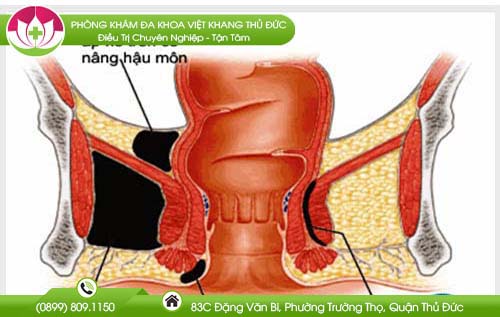 Nguyên nhân gây áp xe hậu môn