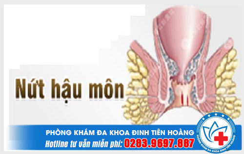 Nguyên nhân nứt hậu môn và cách điều trị
