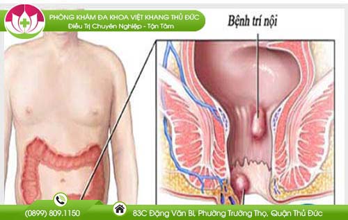 nhin-di-ve-sinh-nhieu-ngay-co-the-dan-den-benh-tri