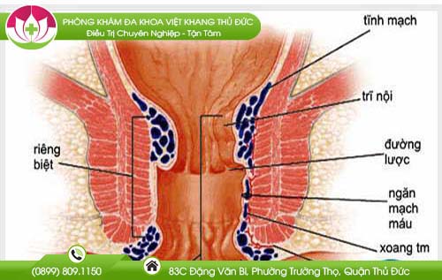 Những biến chứng của bệnh trĩ và thuốc trị