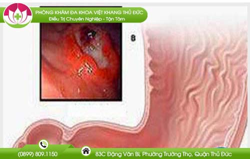 Những cách làm giảm cơn đau dạ dày tức thời
