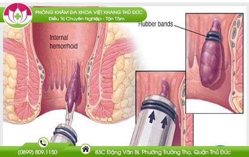 Những điều cần biết về phương pháp điều trị bệnh trĩ bằng cách thắt vòng cao su