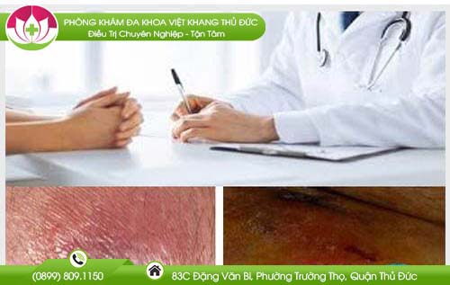 Nổi hạch ở hậu môn là triệu chứng của bệnh gì? Các bệnh hậu môn - trực tràng